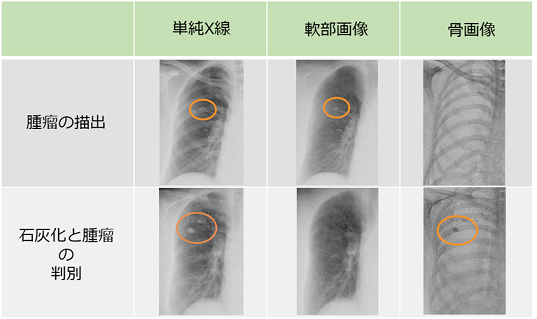 軟部腫瘤の描出とX線エネルギーによる組織の弁別の図