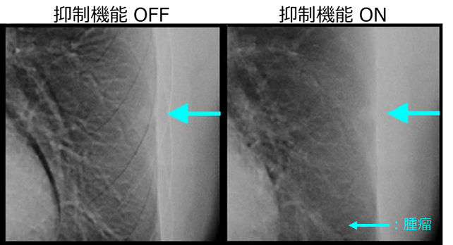 モーションアーチファクト抑制機能ON・OFF比較