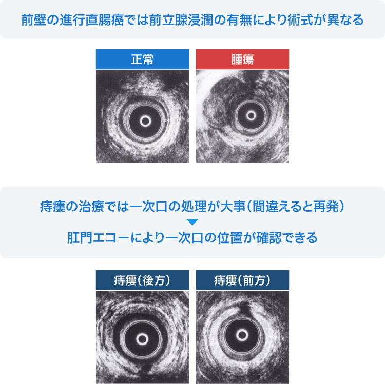 経肛門的超音波検査イメージ01